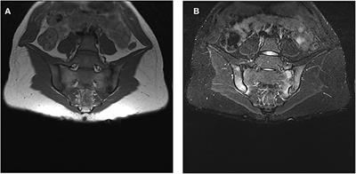 Spine and Sacroiliac Joints Lesions on Magnetic Resonance Imaging in Early Axial-Spondyloarthritis During 24-Months Follow-Up (Italian Arm of SPACE Study)